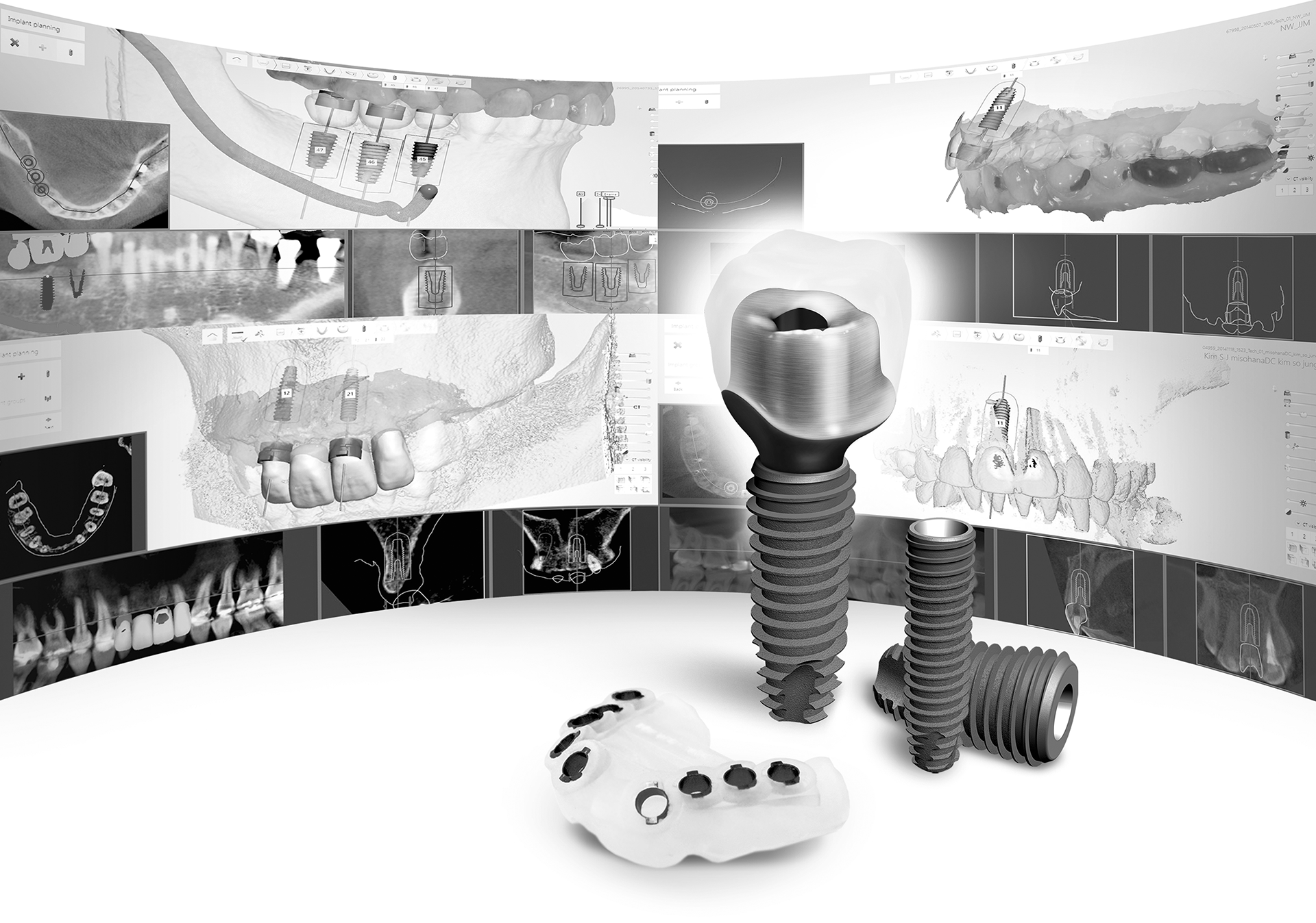 서울드림치과 임플란트 재수술